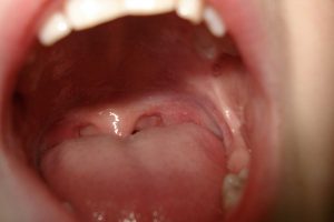Tongue-Disorders-Facts