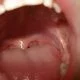 Tongue-Disorders-Facts