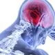 cerebral-infarction