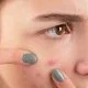 rid-of-acne-scars