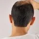 NeoGraft Hair Transplant