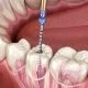How long does a root canal take